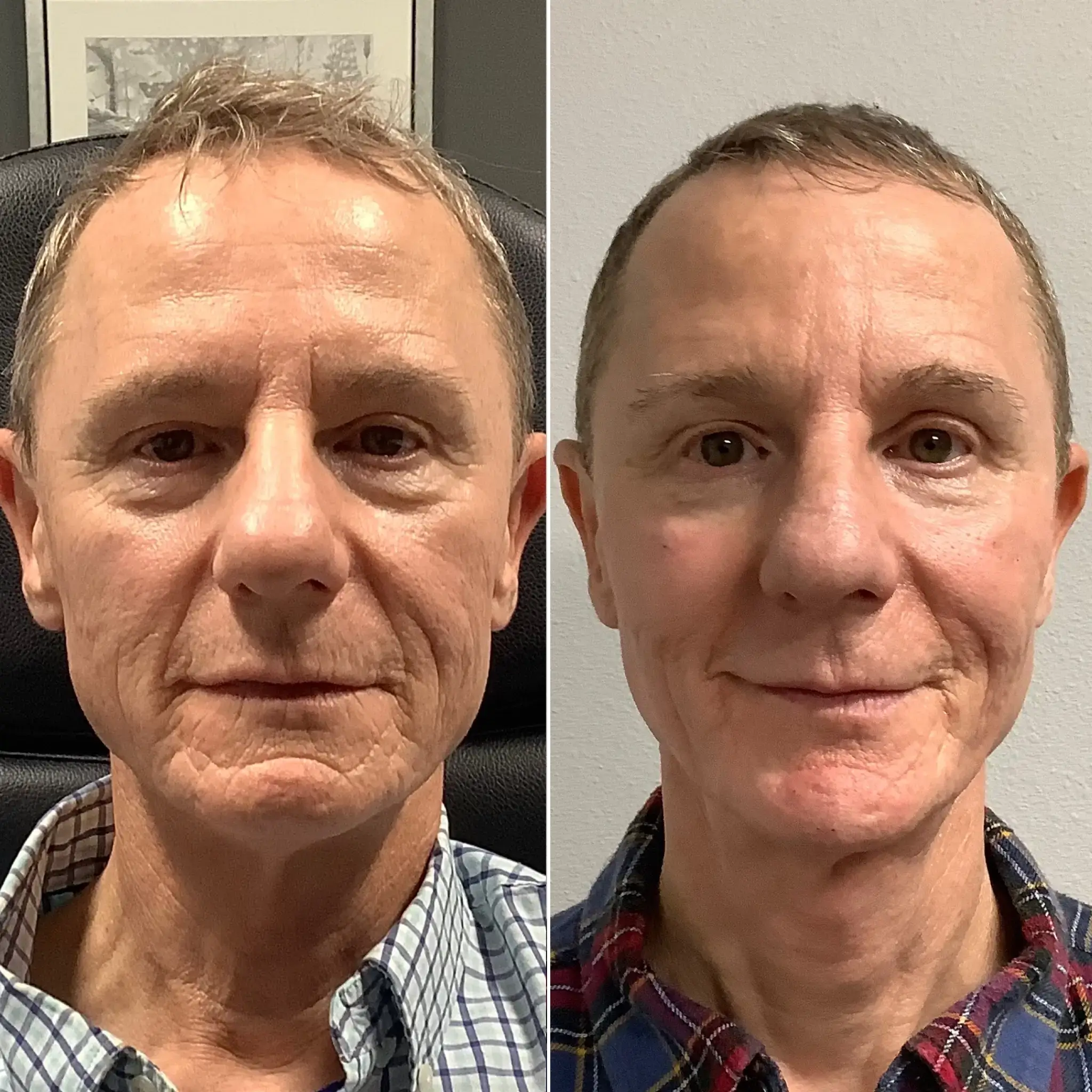 Wrinkles & Anti-Aging Filler Treatments - Larkspur Med Spa Before and after photos of a man after a dermal filler treatment at a Larkspur Med Spa