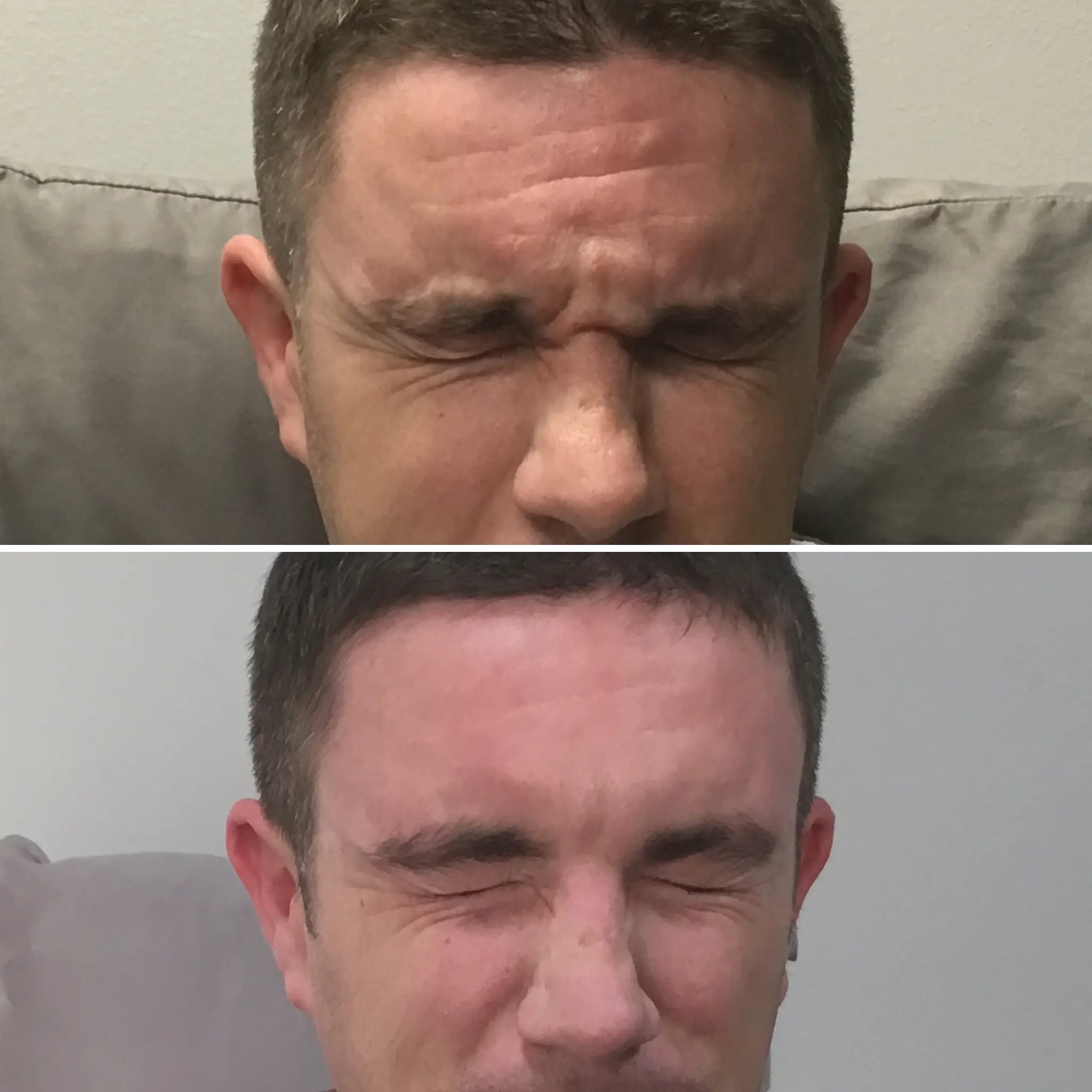 Wrinkles & Anti-Aging Injectables Treatments - Larkspur Med Spa Before and after photos of a man after an injectable treatment at a Larkspur Med Spa