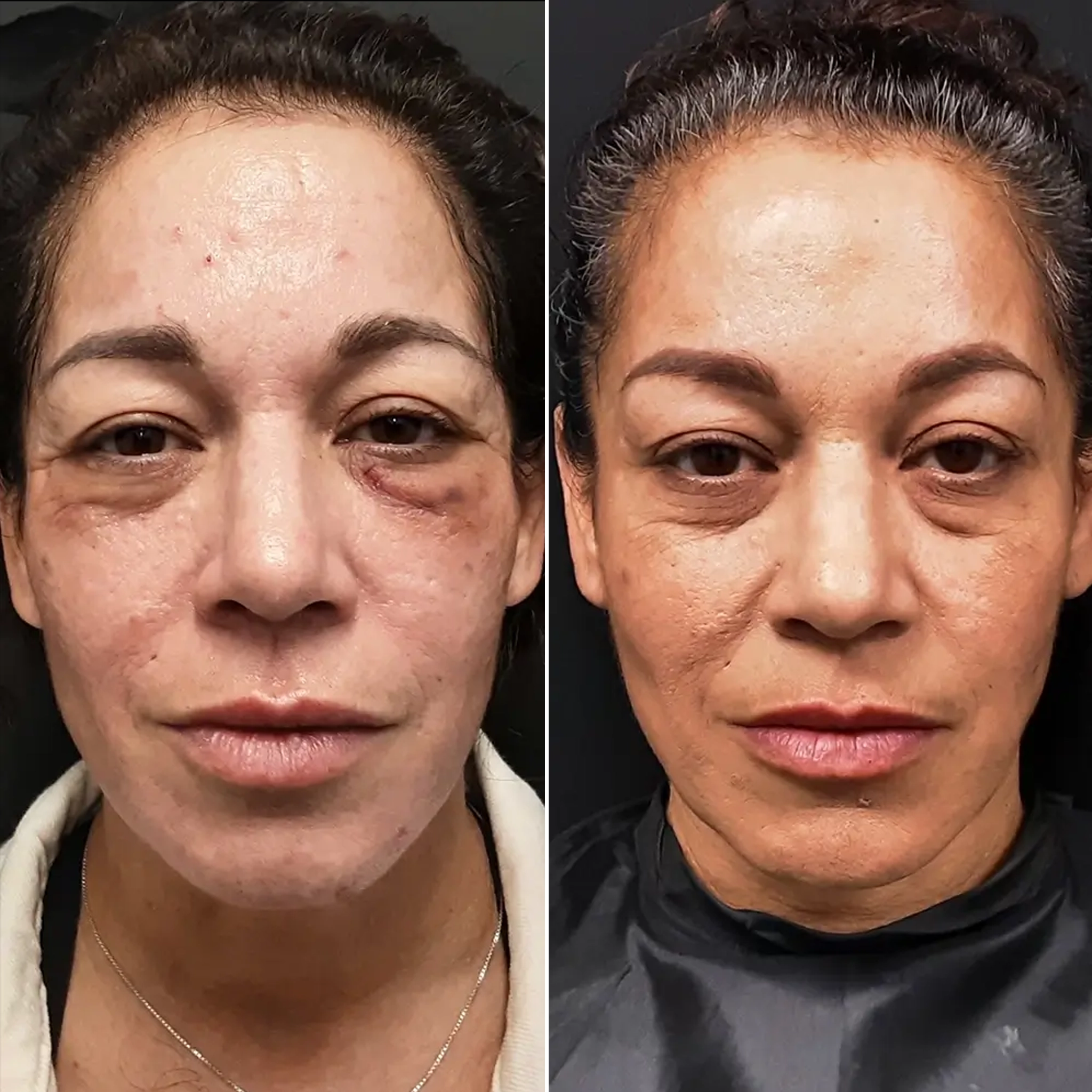 Before and after photos of a woman after a laser treatment at a Larkspur Med Spa